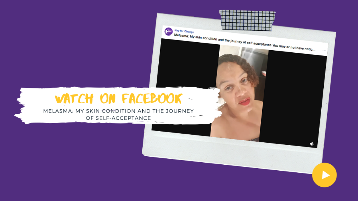 Melasma: My skin condition and the journey of self-acceptance